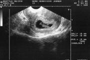 When is it better to do the first ultrasound during pregnancy and what does it show?