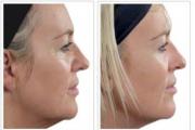 Myostimulation - a procedure for facial skin rejuvenation