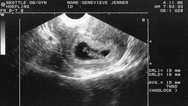 When is it better to do the first ultrasound during pregnancy and what does it show?