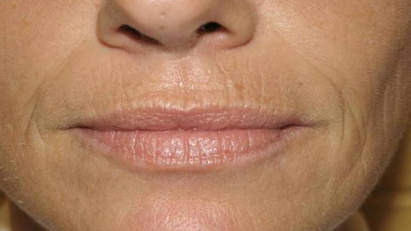 How to remove wrinkles above the upper lip with cosmetic procedures and at home