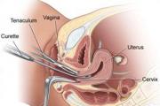Smrznuta trudnoća - znakovi, uzroci, simptomi, testovi