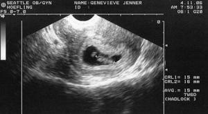 Millal on parem teha esimene ultraheli raseduse ajal ja mida see näitab?